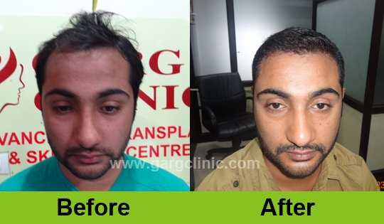 Garg Hair Transplant Clinic