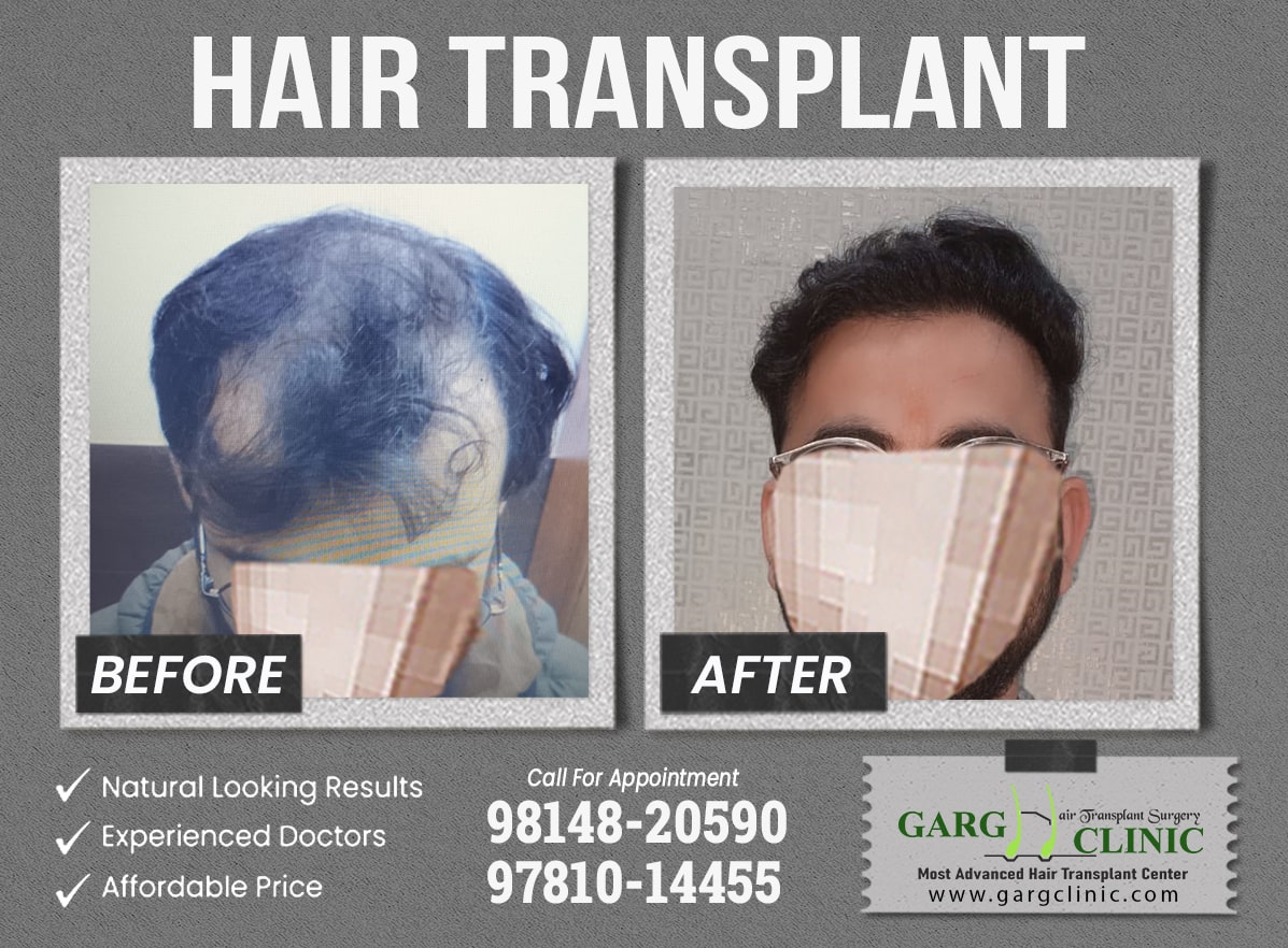 Garg Hair Transplant Clinic