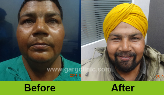 Garg Hair Transplant Clinic