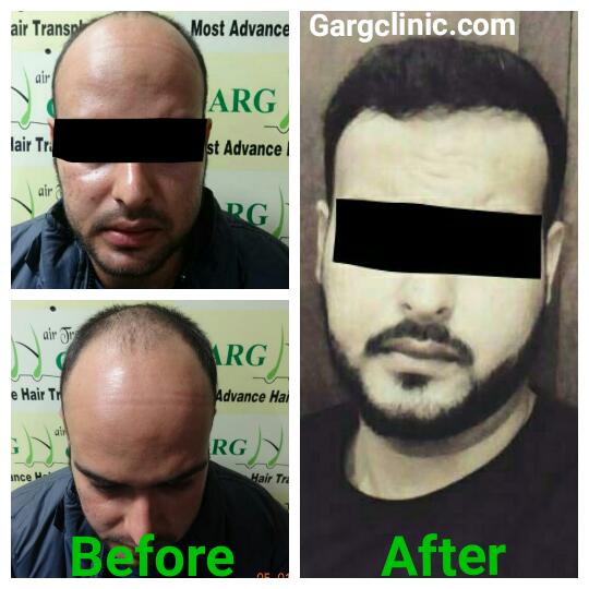 Garg Hair Transplant Clinic
