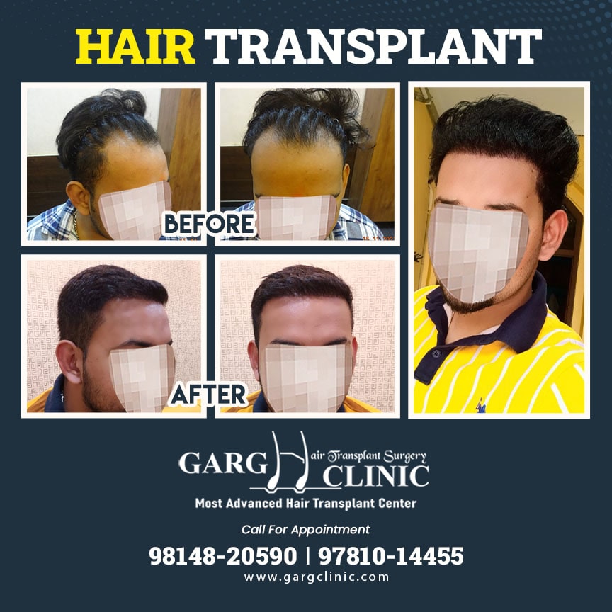 Garg Hair Transplant Clinic