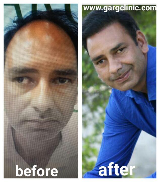 Garg Hair Transplant Clinic