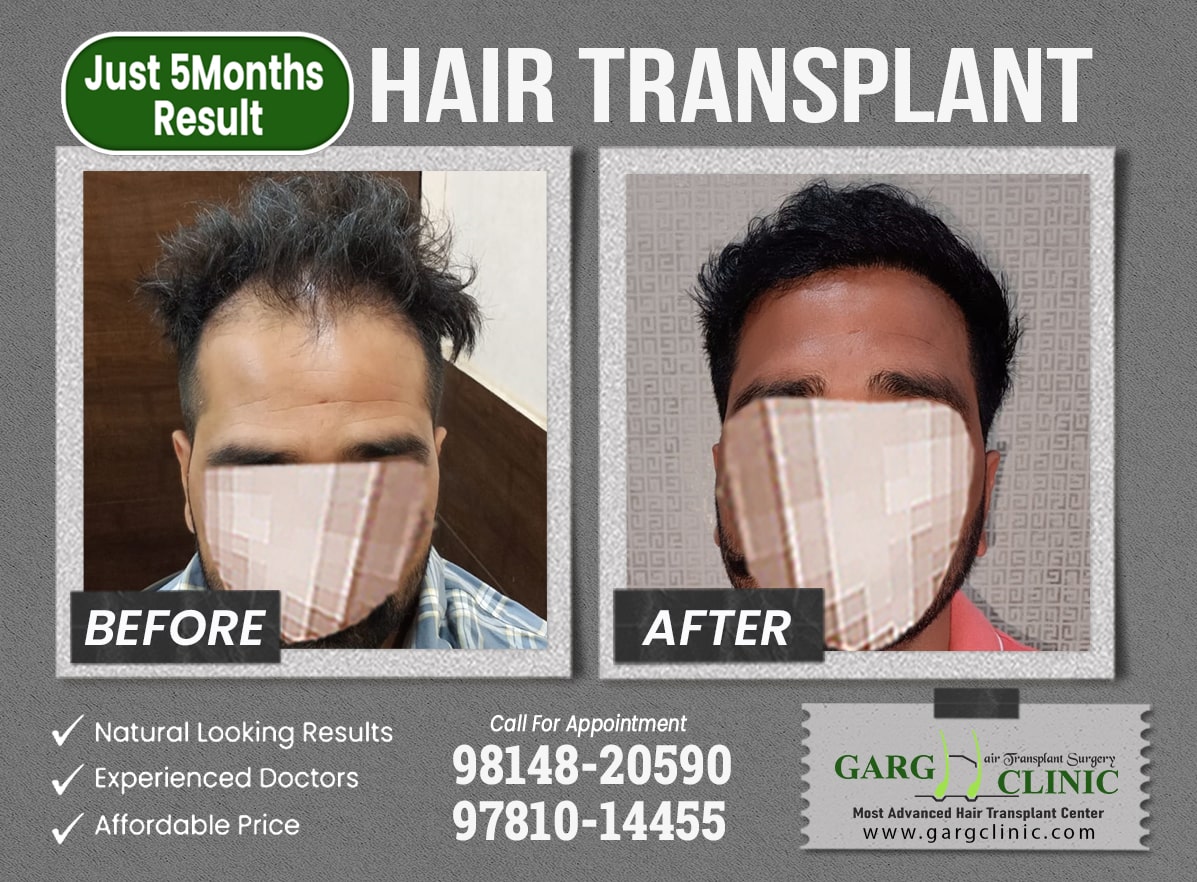 Garg Hair Transplant Clinic
