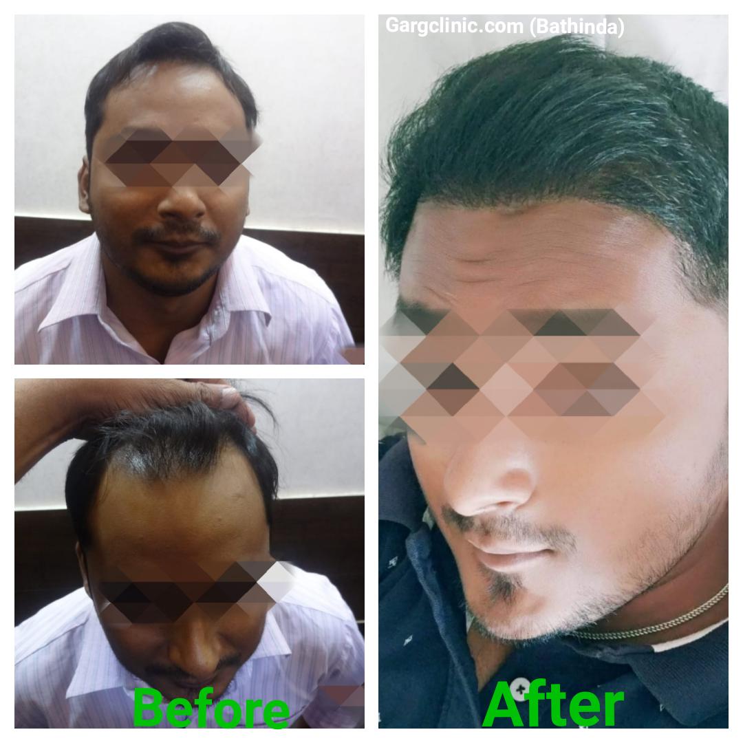 Garg Hair Transplant Clinic