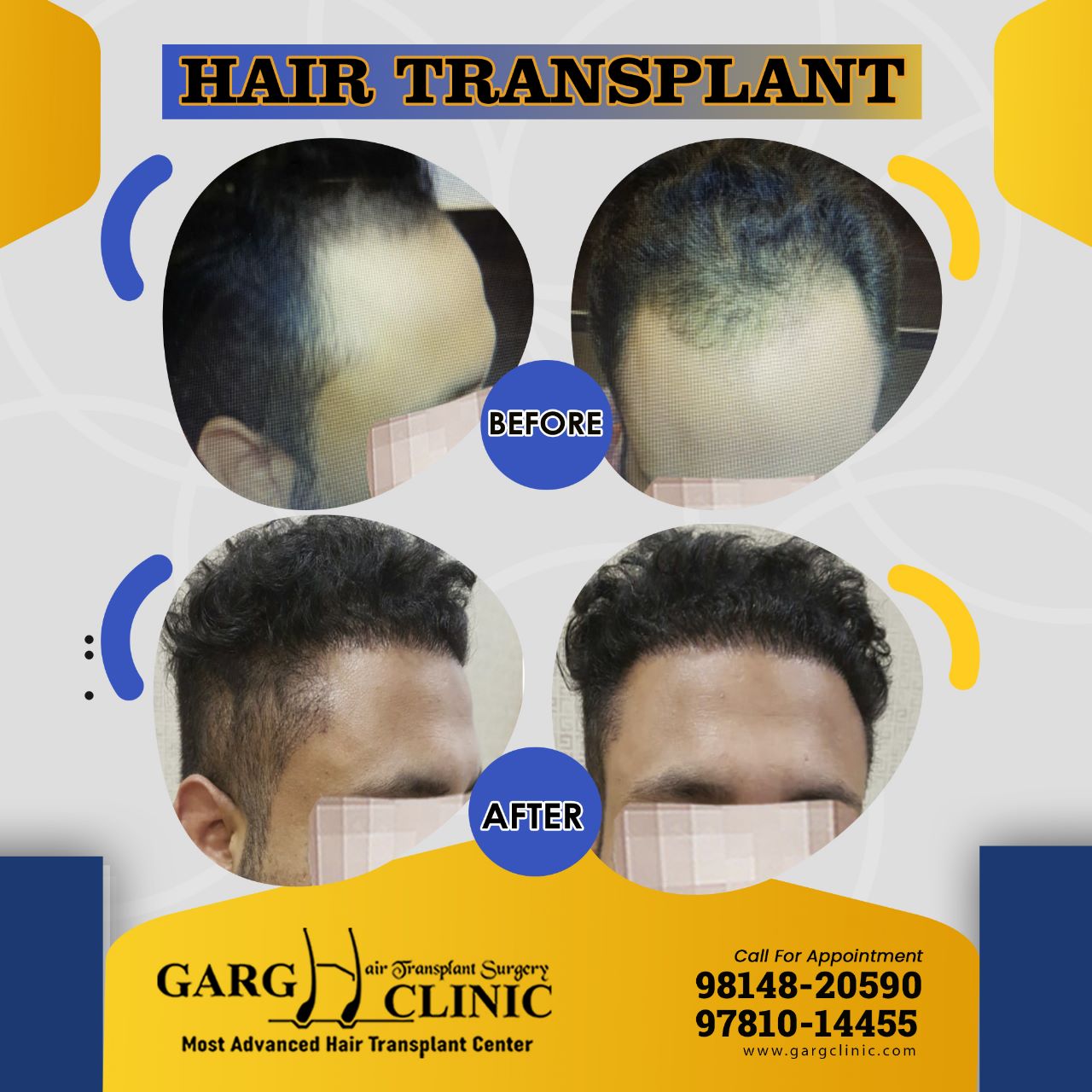 Garg Hair Transplant Clinic