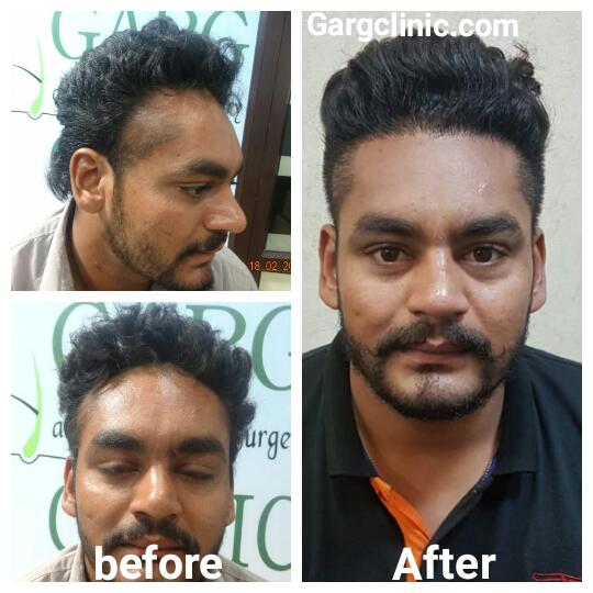 Garg Hair Transplant Clinic