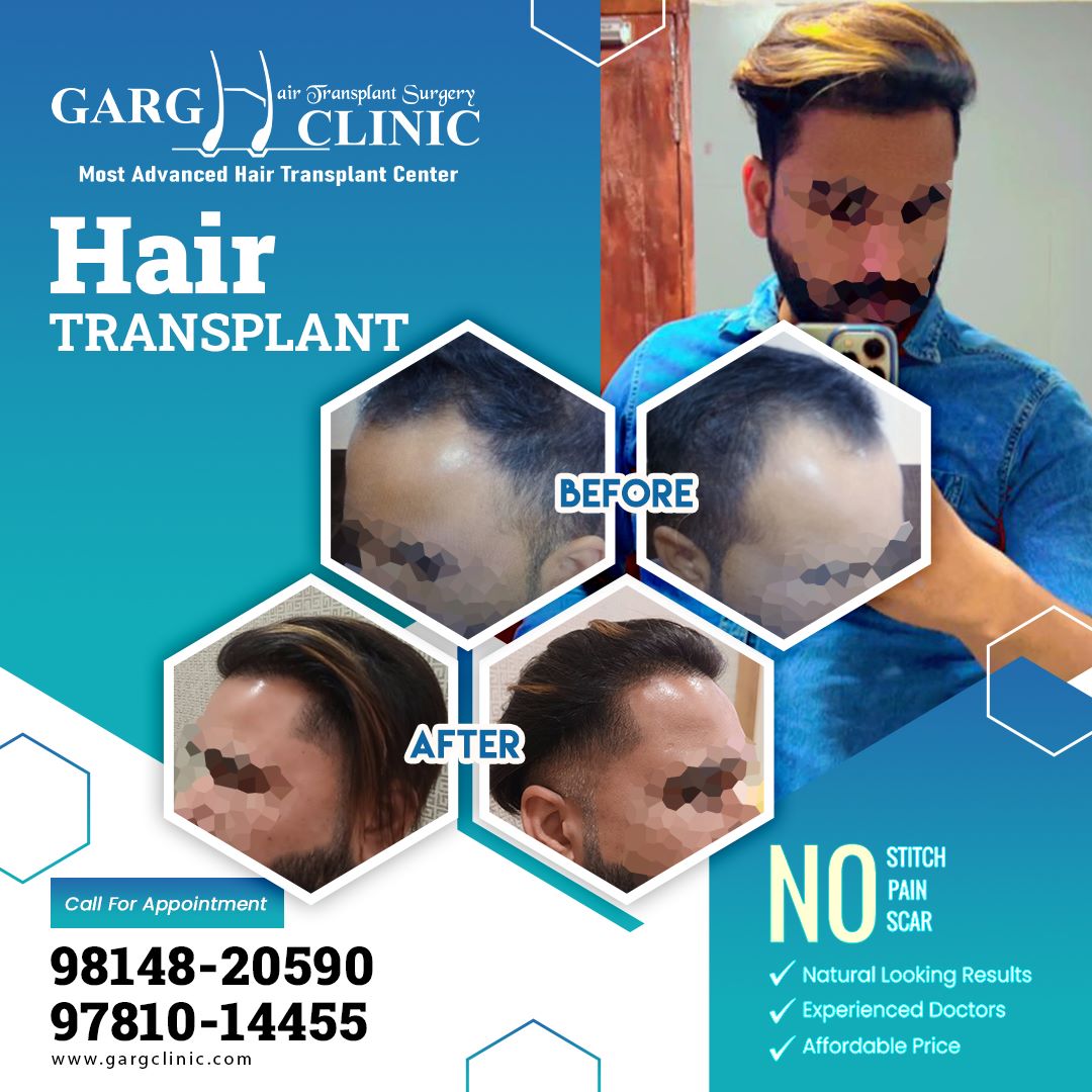Garg Hair Transplant Clinic