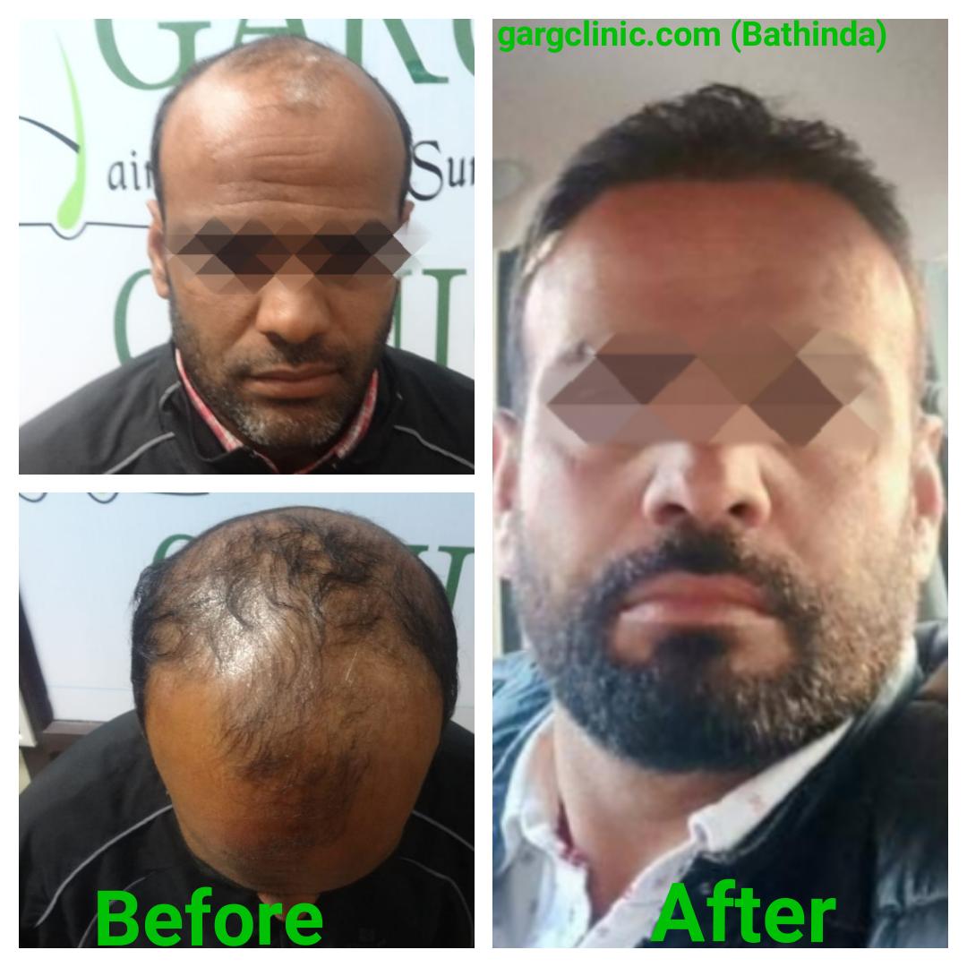Garg Hair Transplant Clinic