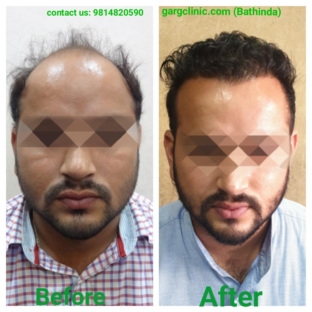 Garg Hair Transplant Clinic