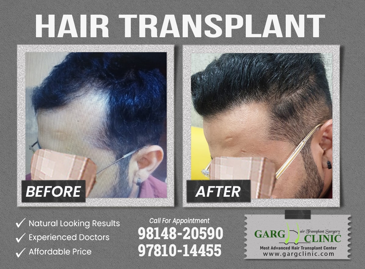 Garg Hair Transplant Clinic