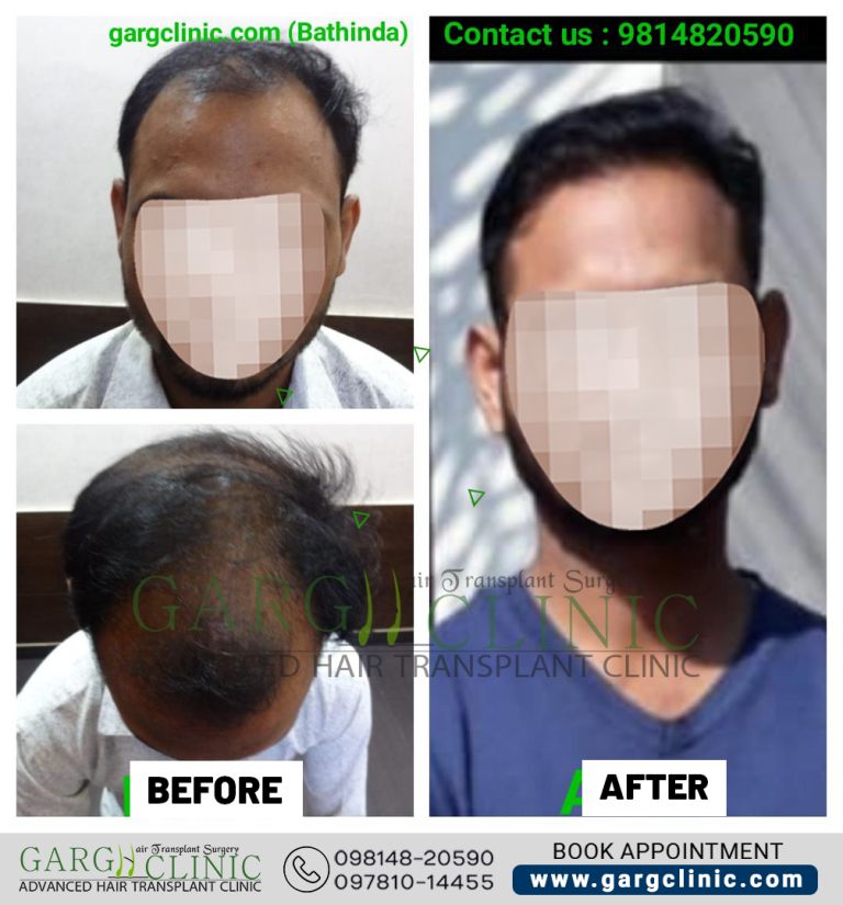 Garg Hair Transplant Clinic