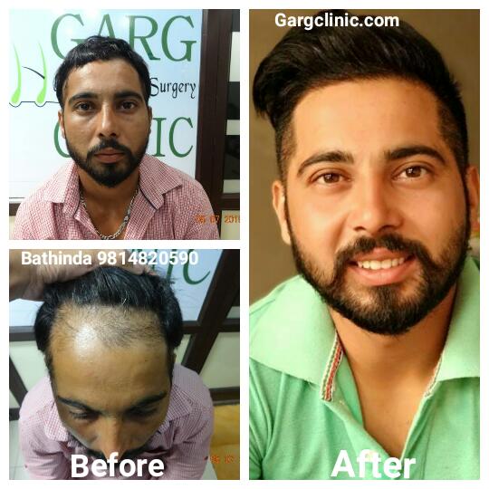 Garg Hair Transplant Clinic