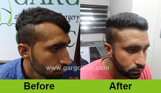 Garg Hair Transplant Clinic