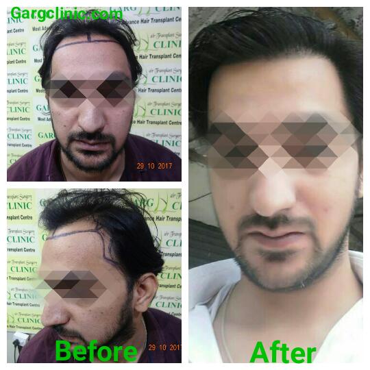 Garg Hair Transplant Clinic