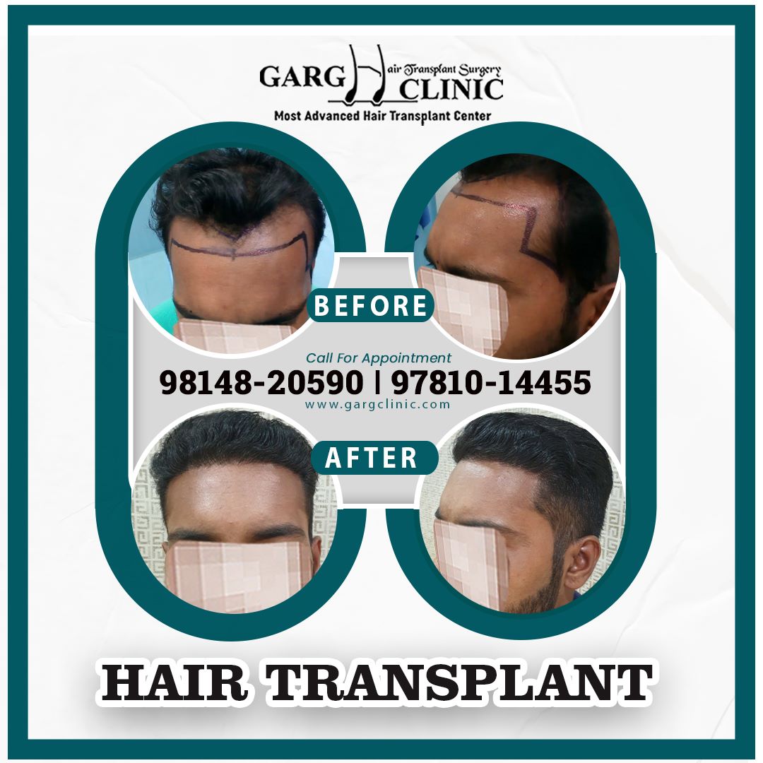 Garg Hair Transplant Clinic