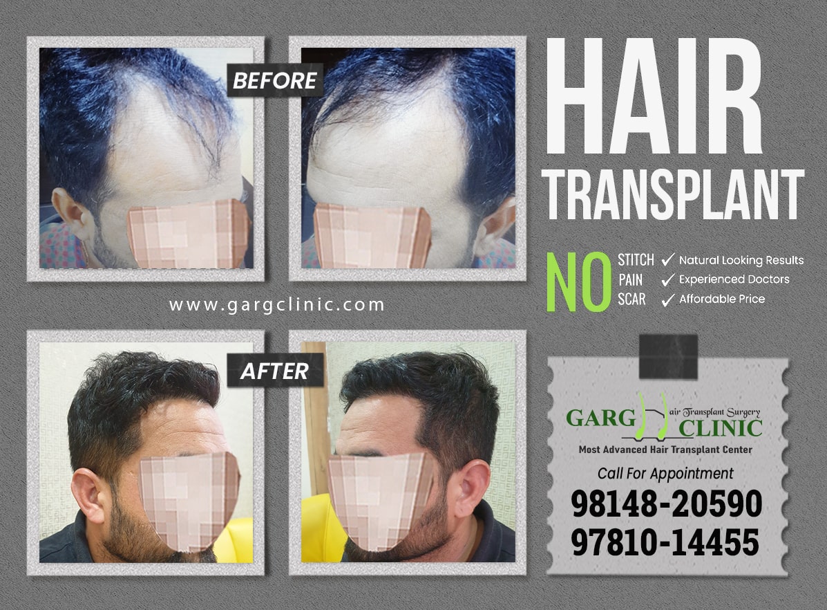 Garg Hair Transplant Clinic