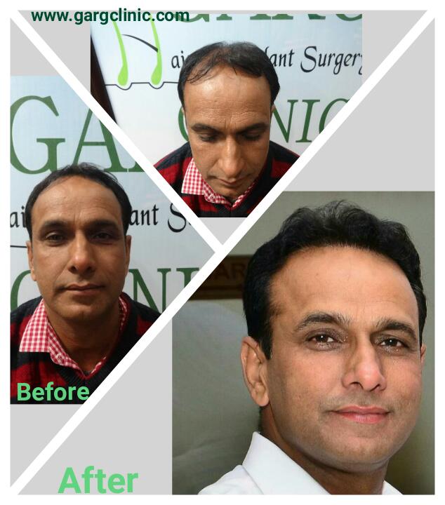 Garg Hair Transplant Clinic