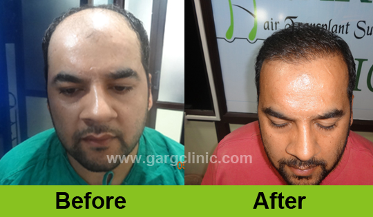 Garg Hair Transplant Clinic