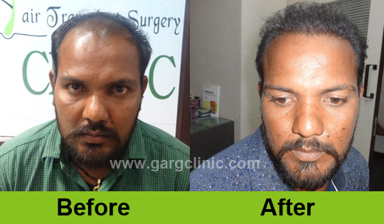 Garg Hair Transplant Clinic