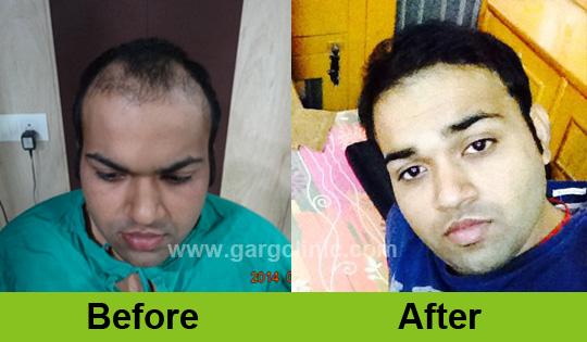 Garg Hair Transplant Clinic