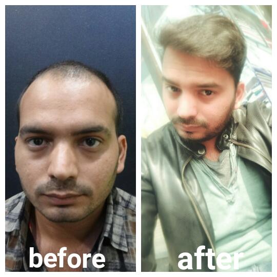 Garg Hair Transplant Clinic