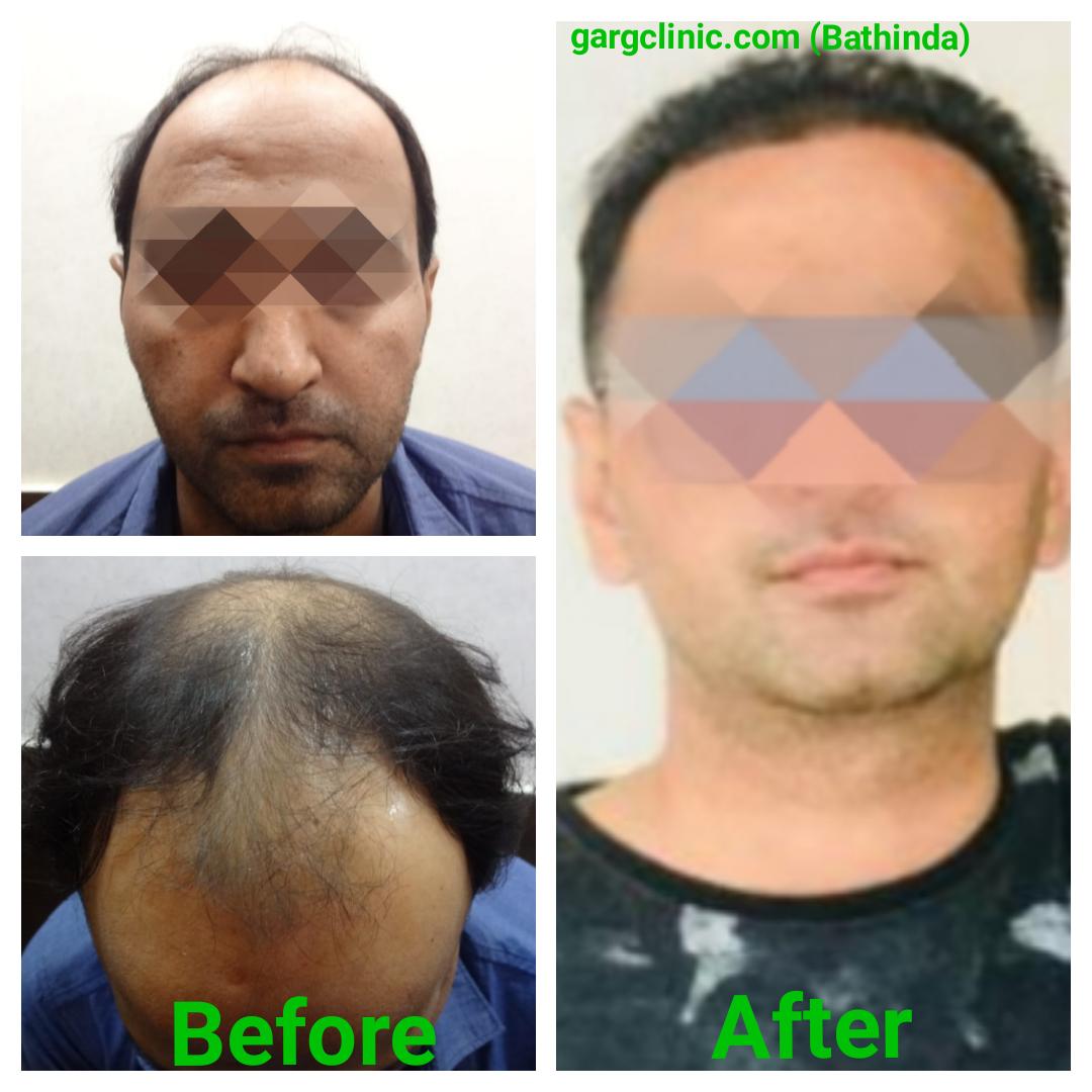 Garg Hair Transplant Clinic