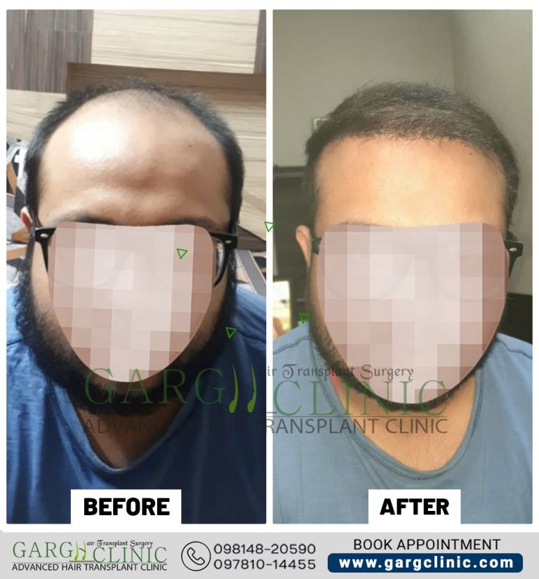 Garg Hair Transplant Clinic
