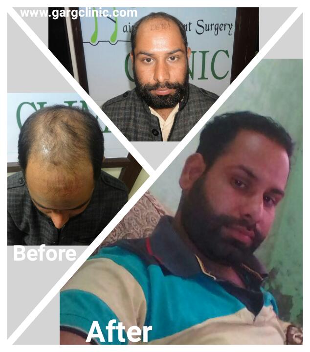 Garg Hair Transplant Clinic
