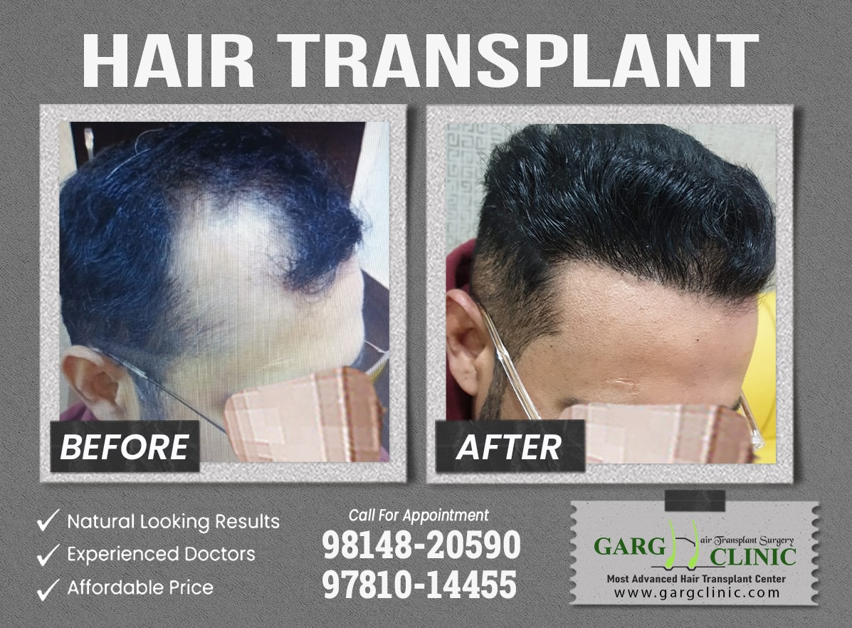Garg Hair Transplant Clinic