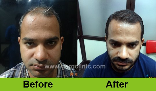 Garg Hair Transplant Clinic