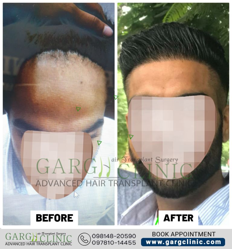 Garg Hair Transplant Clinic
