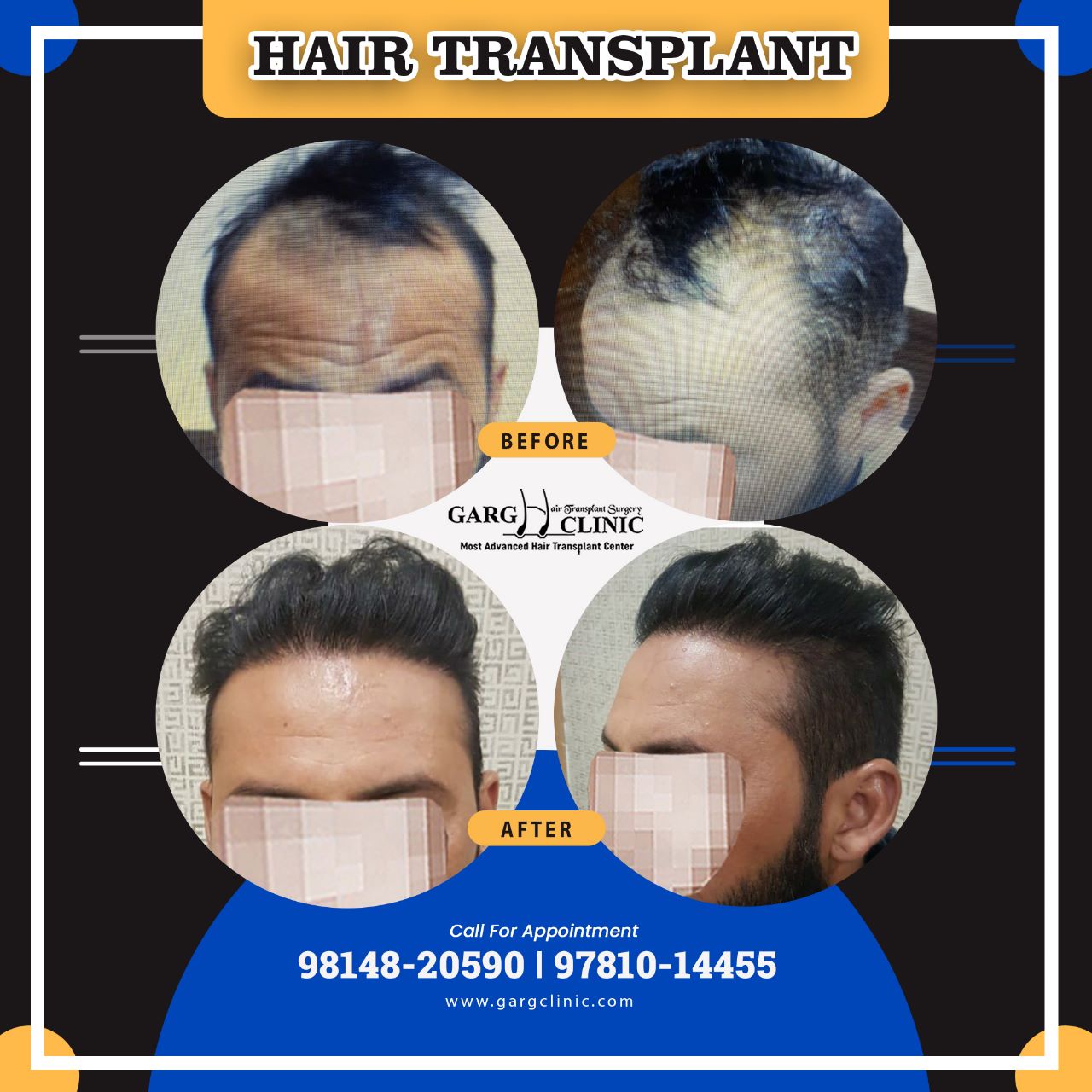 Garg Hair Transplant Clinic