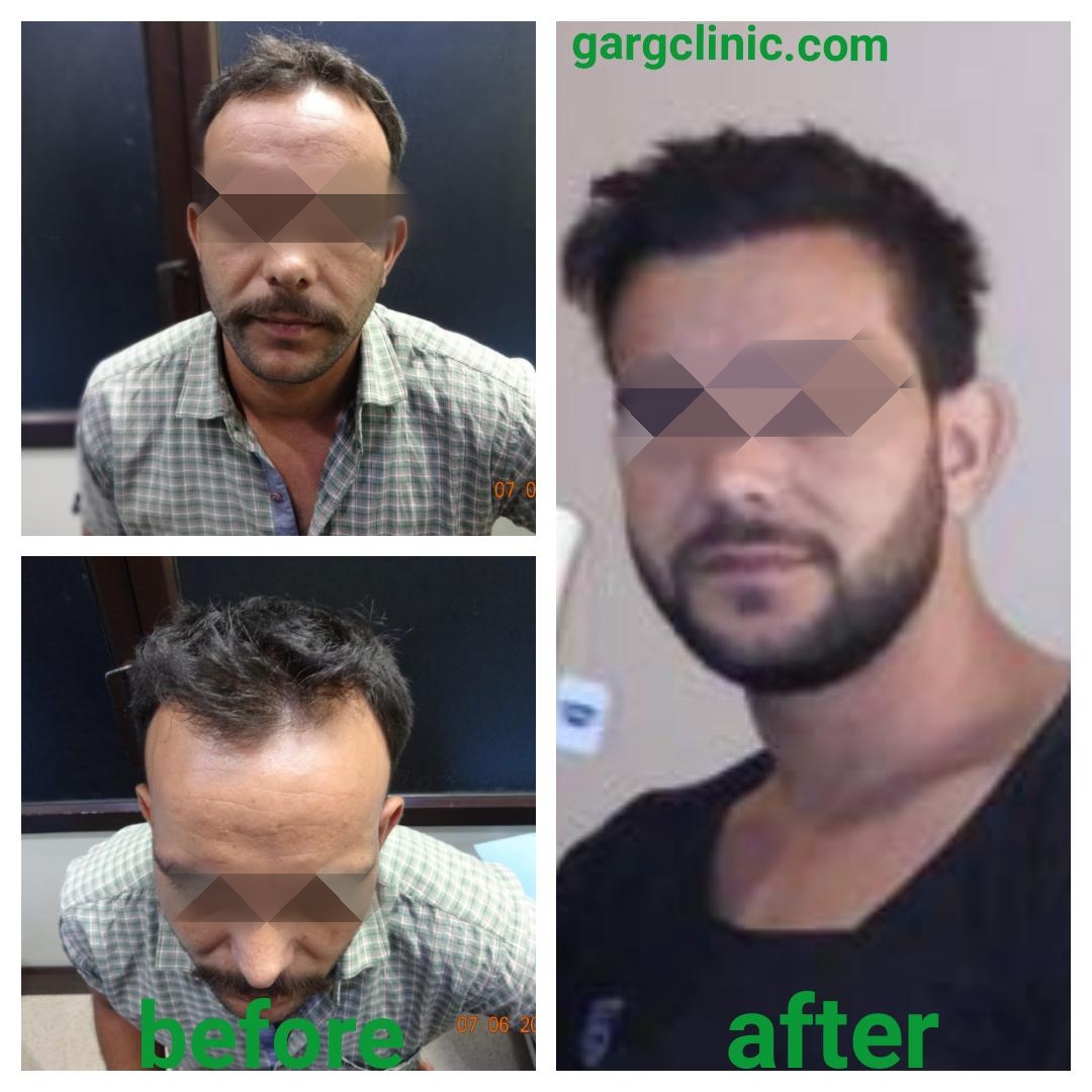 Garg Hair Transplant Clinic