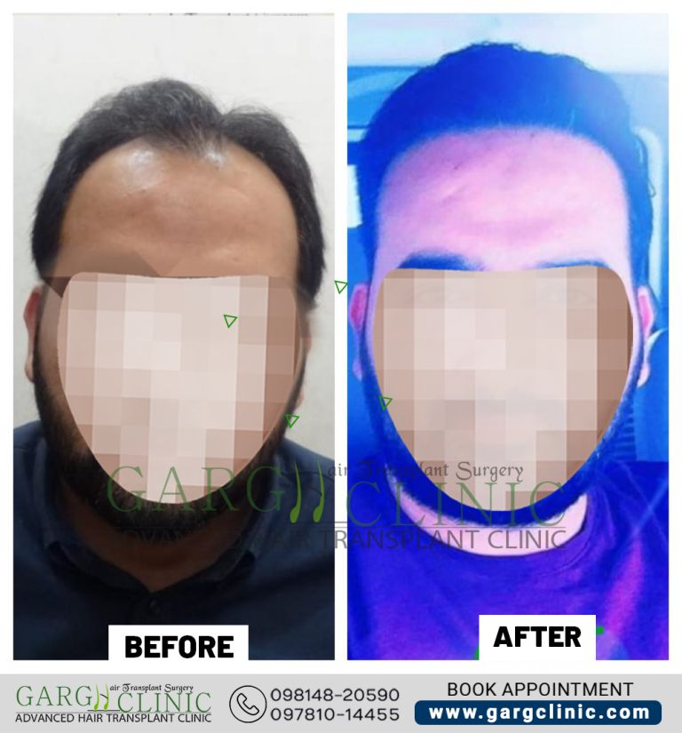 Garg Hair Transplant Clinic
