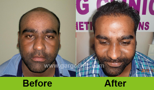 Garg Hair Transplant Clinic