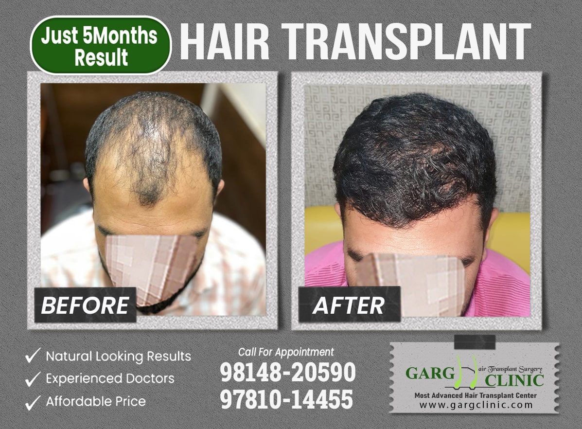 Garg Hair Transplant Clinic