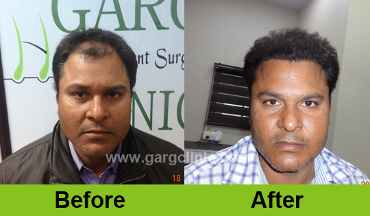 Garg Hair Transplant Clinic