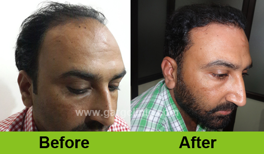 Garg Hair Transplant Clinic