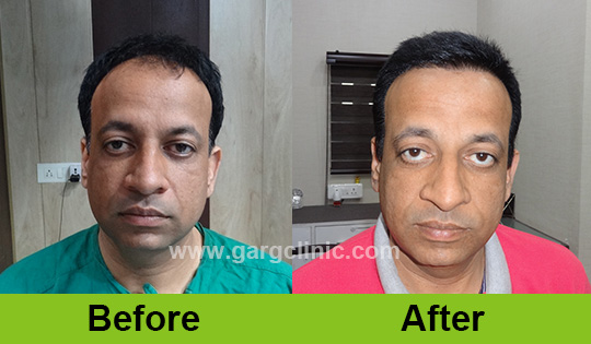 Garg Hair Transplant Clinic
