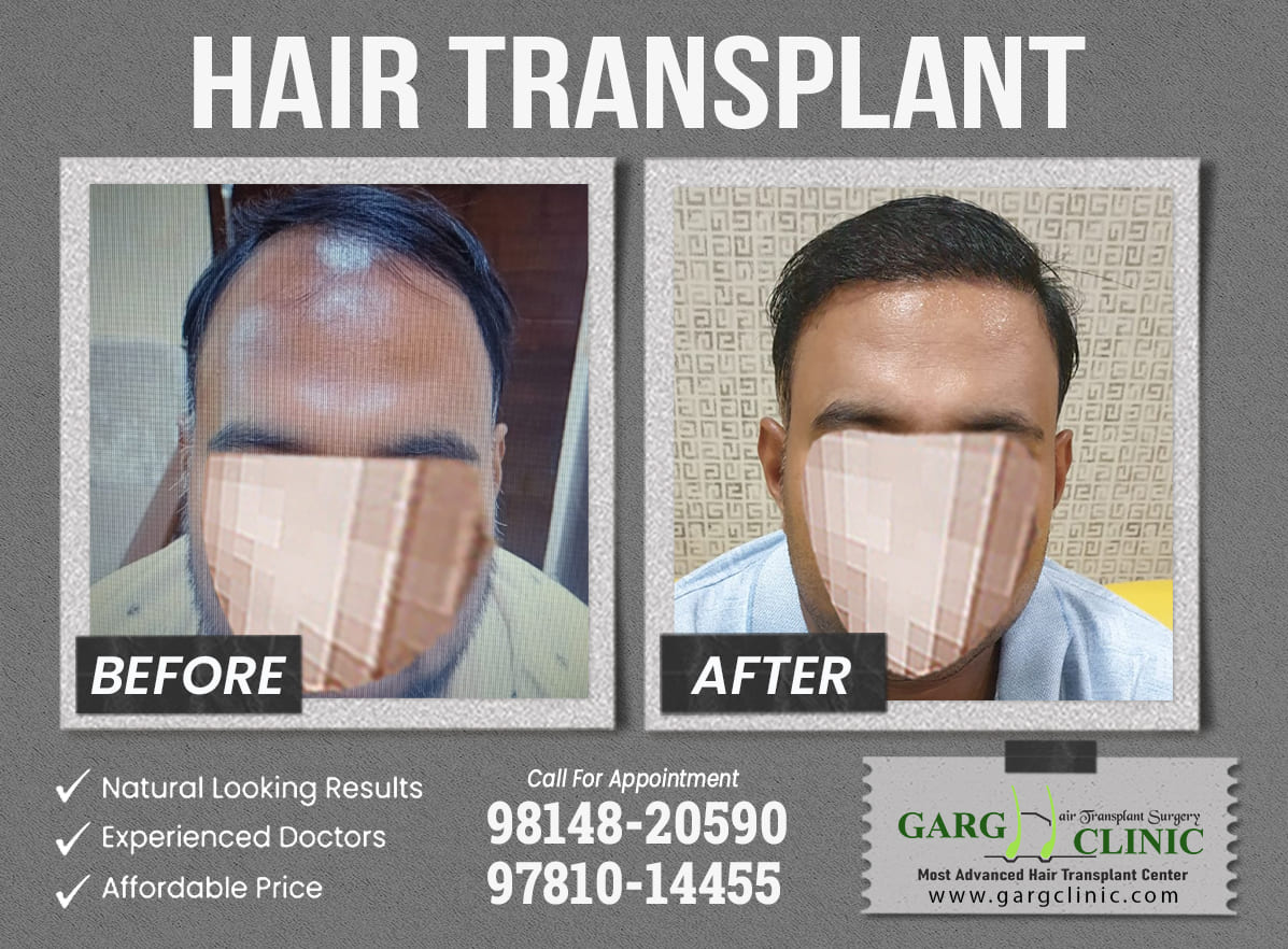 Garg Hair Transplant Clinic