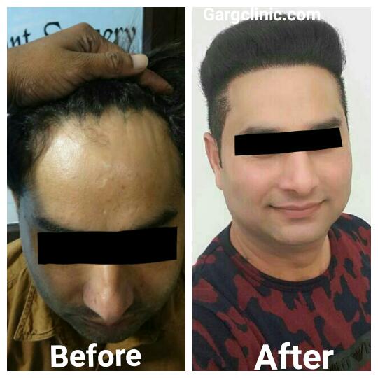 Garg Hair Transplant Clinic