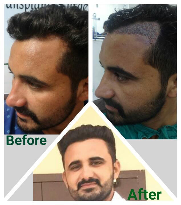 Garg Hair Transplant Clinic