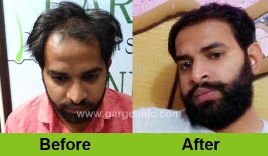 Garg Hair Transplant Clinic
