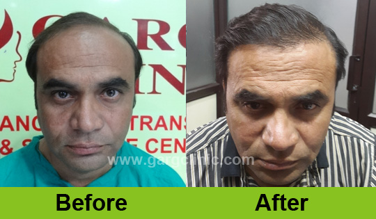 Garg Hair Transplant Clinic