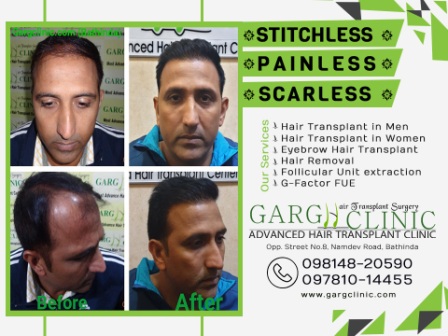 Garg Hair Transplant Clinic