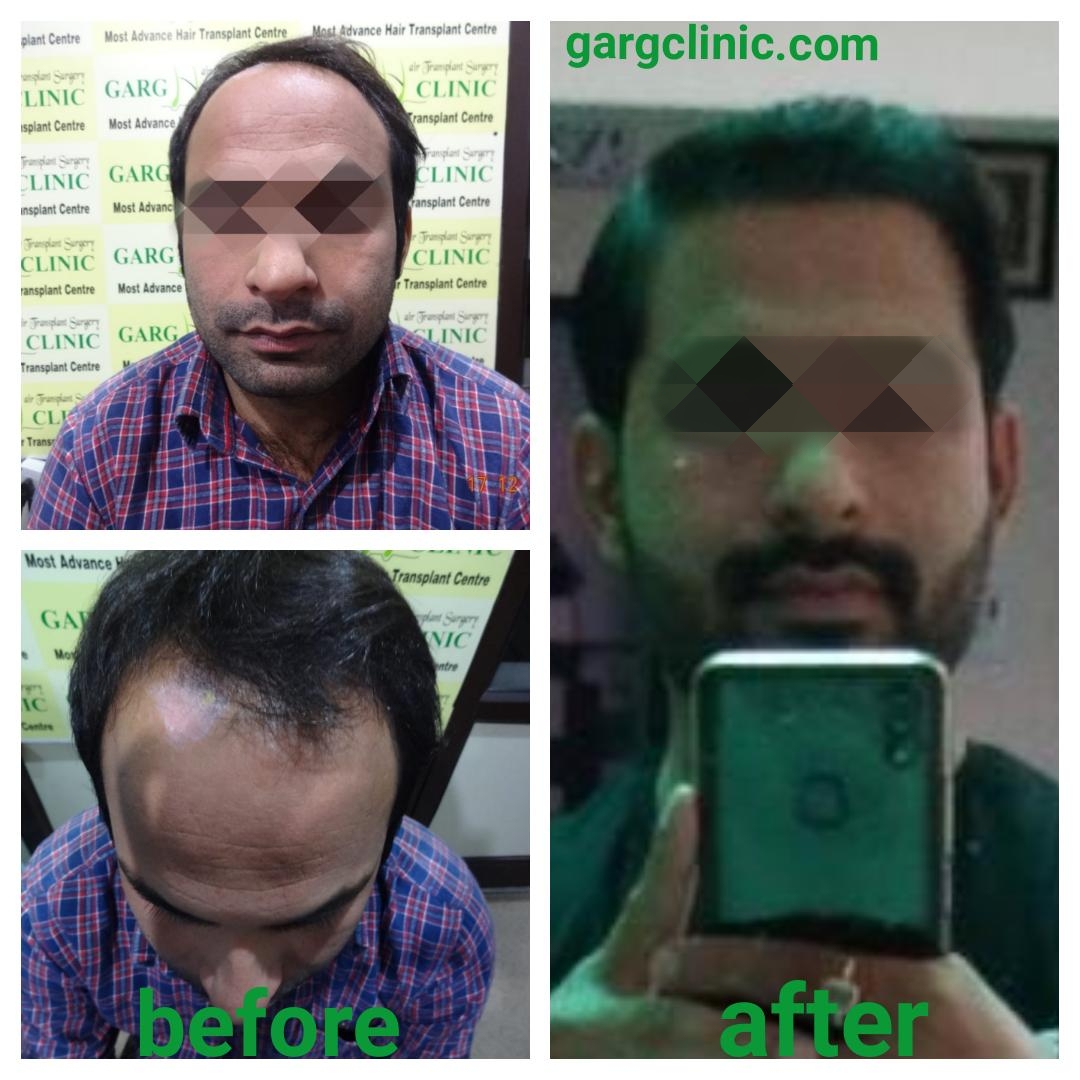 Garg Hair Transplant Clinic