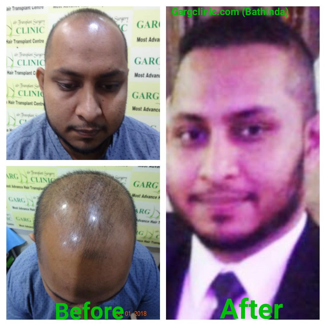 Garg Hair Transplant Clinic