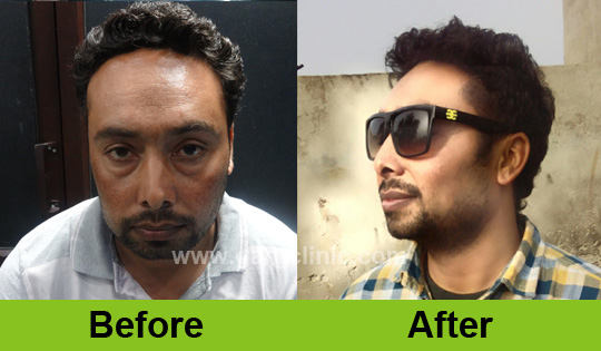 Garg Hair Transplant Clinic