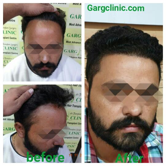 Garg Hair Transplant Clinic