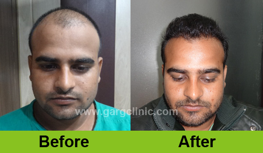 Garg Hair Transplant Clinic